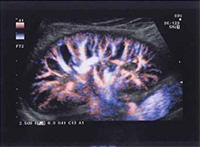 臨床検査科8 腎ドップラー検査