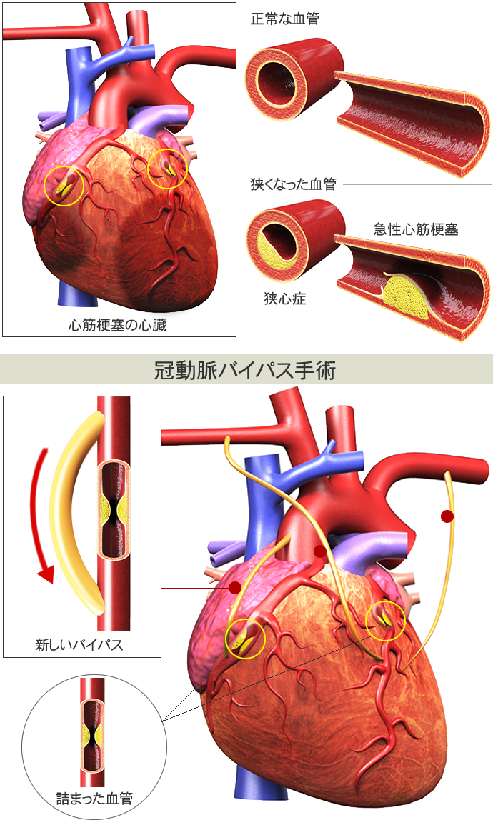 心臓 バイパス 手術 後 の 生活